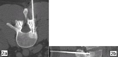 Termoablazione delle lesioni del sistema muscolo scheletrico ior